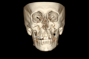 Tomografia do acidente de bicicleta do Doug – Maxilar fraturado